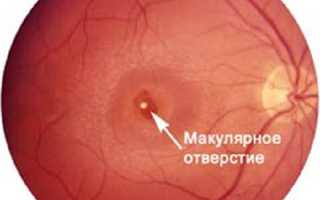 Макулярный разрыв сетчатки: единственный способ исправить дефект — хирургическое вмешательство