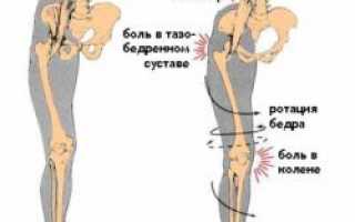 Что делать если болят колени от плоскостопия: находим связь и решаем проблему