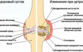 Народные средства от артроза — пошаговые рецепты настоев, отваров, компрессов и мазей с фото