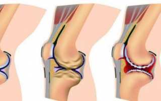 Феморопателлярный артроз — симптомы и лечение