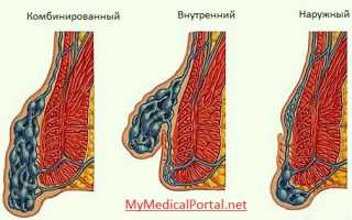 Что такое геморрой, как выглядит и какое лечение необходимо?