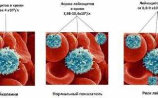 Причины пониженных лейкоцитов в крови