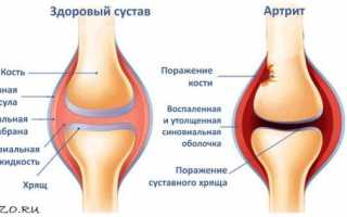 Почему болит коленная чашечка: причины, симптомы, лечение