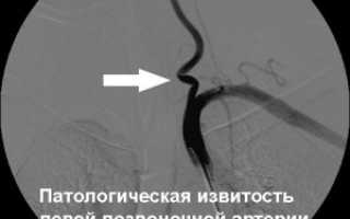 Экстравазальная компрессия позвоночной артерии: симптомы, причины, диагностика и лечение