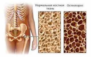 Поражение опорно-двигательного аппарата при ВИЧ-инфекции