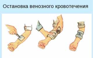 Как остановить венозное кровотечение?