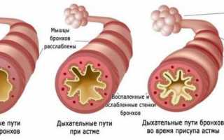 Хрипы в горле: как возникают, причины и болезни, симптоматика, диагностика, терапия