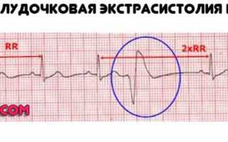 Желудочковая экстрасистолия