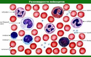 Лейкоцитоз (повышенные лейкоциты в крови): норма или патология?