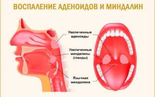 После удаления аденоидов ребенок храпит
