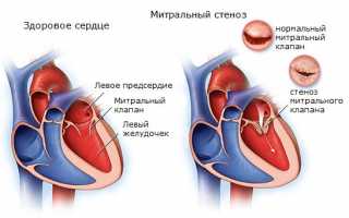 Почему возникает дилатация левого желудочка сердца?