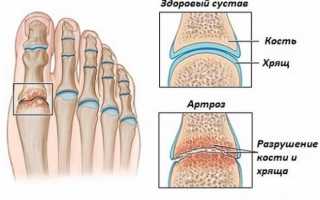 Артроз стопы — причины, первые симптомы и проявления, диагностика, лечение медикаментами и гимнастикой