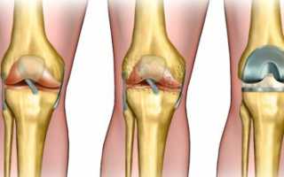Уколы при артрозе коленного сустава