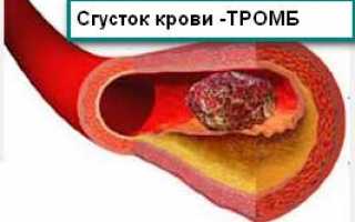 Подсчет тромбоцитов по Фонио – точен ли метод?