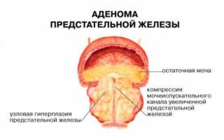 Норма анализа ПСА для мужчин старше 60 лет и как снизить повышенный антиген