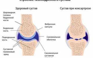 Причины появления боли в тазобедренном суставе ночью лежа на боку, сопутствующая симптоматика
