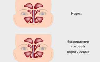 Катаральный синусит – виды и лучшие методы лечения