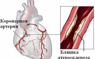 Методы реваскуляризации миокарда – что это такое