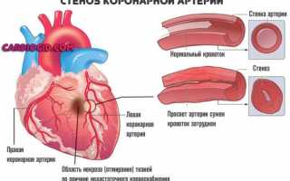 Трансмуральный инфаркт миокарда: что это такое, опасности и лечение