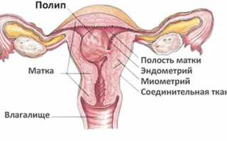 Почему возникают полипы эндометрия и как их лечить