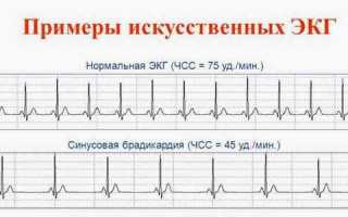 Синусовая брадикардия сердца: что это такое, причины, лечение и прогноз