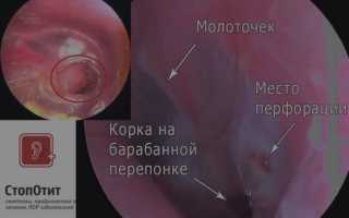 Втянутая барабанная перепонка: от чего возникает патология и способы лечения