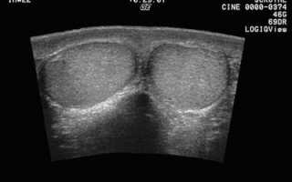 Ультразвуковое сканирование (УЗИ) мошонки