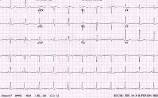 Инфаркт на ЭКГ — признаки и расшифровка