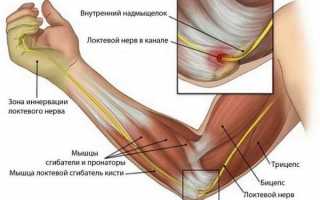 Защемление нерва в локтевом суставе — симптомы и лечение заболевания