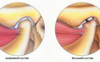 Почему при жевании возле уха болит челюсть с одной стороны: что означает боль справа и слева, чем лечить?