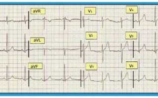Чем опасен синдром ранней реполяризации желудочков