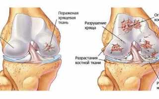 Лучшие хондропротекторы при артрозе коленного сустава и других: классификация, цены