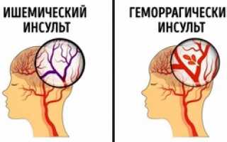 Инсульт правой стороны: последствия и методы лечения