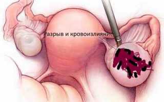 Геморрагическая киста яичника
