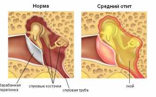 Щелкает в ухе при глотании и ходьбе