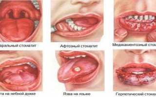 Заболевания языка и полости рта: фото и названия болезней слизистой оболочки у взрослых, способы лечения