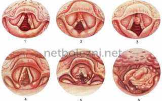 Симптомы рака горла на ранних стадиях
