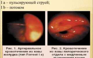 Классификация кровотечений по Форесту: значение, особенности и лечение