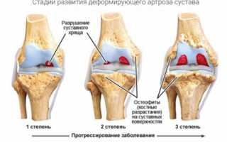 Применение скипидара для лечения болезней суставов