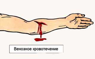 Венозное кровотечение