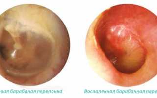 Воспаление барабанной перепонки: причины, симптомы и лечение