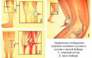 Гигрома коленного сустава: фото, причины появления, симптомы и лечение