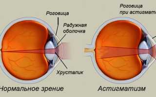 Какие главные симптомы и причины астигматизма у взрослых? Виды, признаки и степени заболевания