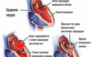 Дилатация левого предсердия: причины и степени, симптомы и лечение