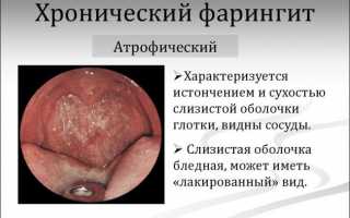 Заболевания горла и гортани: симптомы и лечение болезни