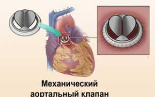 Замена сердечного клапана