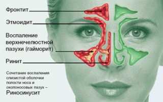 Надо ли бояться прокола гайморовой пазухи