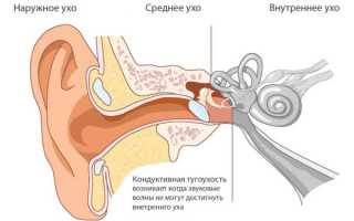 Сенсоневральная тугоухость 3 степени – дают ли инвалидность, какую группу