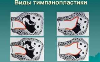 Как правильно лечить разрыв барабанной перепонки, основные симптомы и последствия травмы