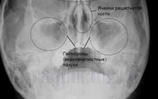 Рентген придаточных пазух носа (ППН): как и зачем делают, снимки, пример описания (расшифровки)